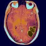 Alarming Rise in Children’s Brain Infections: Discover the Mystery and Stay Informed – Visit Our Site Now!