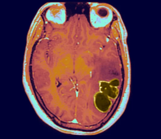 Alarming Rise in Children’s Brain Infections: Discover the Mystery and Stay Informed – Visit Our Site Now!